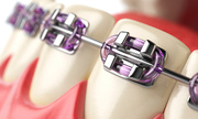 Metal Braces - Vanilla Smiles Dental Clinic,  Dubai