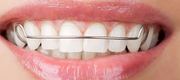 Teeth Straightening - Best Dentist  Union